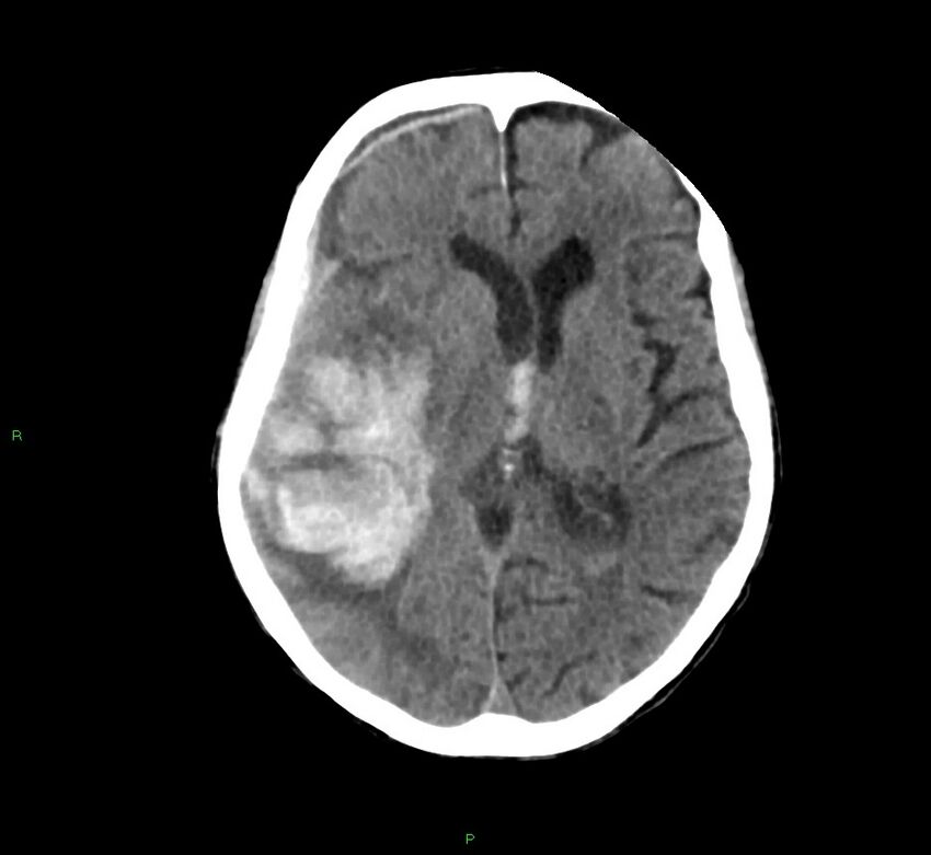 Cerebral amyloid angiopathy-associated lobar intracerebral hemorrhage (Radiopaedia 58758-65980 Axial non-contrast 25).jpg