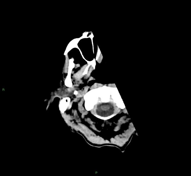 File:Cerebral amyloid angiopathy-associated lobar intracerebral hemorrhage (Radiopaedia 58758-65980 Axial non-contrast 48).jpg