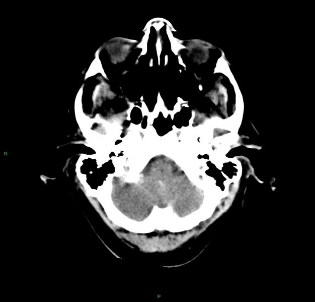 File:Cerebral amyloid angiopathy-associated lobar intracerebral hemorrhage (Radiopaedia 59356-66716 Axial non-contrast 41).jpg