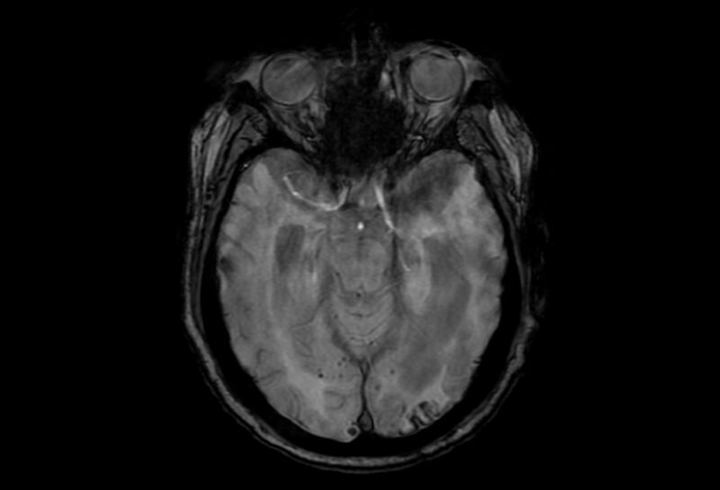 File:Cerebral amyloid angiopathy (Radiopaedia 86671-102792 Axial Gradient Echo 36).jpg