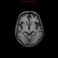 Cerebral and orbital tuberculomas (Radiopaedia 13308-13311 Axial T1 10).jpg