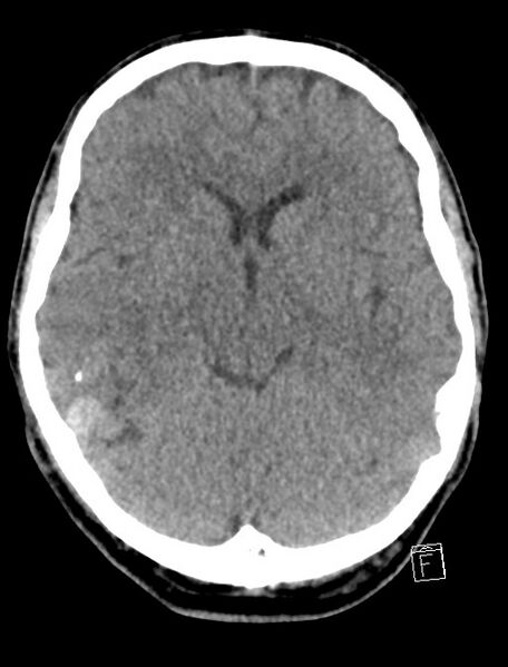 File:Cerebral arteriovenous malformation (Radiopaedia 78188-90745 Axial non-contrast 10).jpg