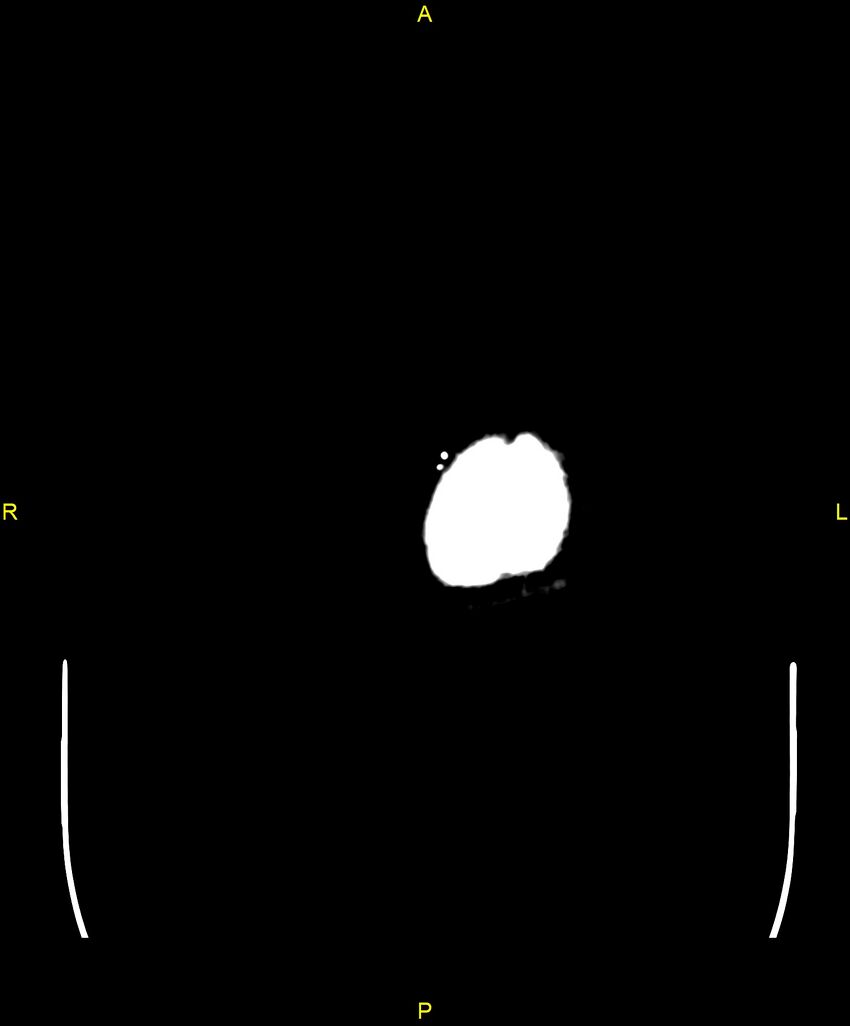 Cerebral autosomal dominant arteriopathy with subcortical infarcts and leukoencephalopathy (CADASIL) (Radiopaedia 86108-102051 Axial non-contrast 121).jpg