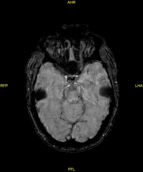 File:Cerebral autosomal dominant arteriopathy with subcortical infarcts and leukoencephalopathy (CADASIL) (Radiopaedia 86108-102054 Axial SWI 42).jpg