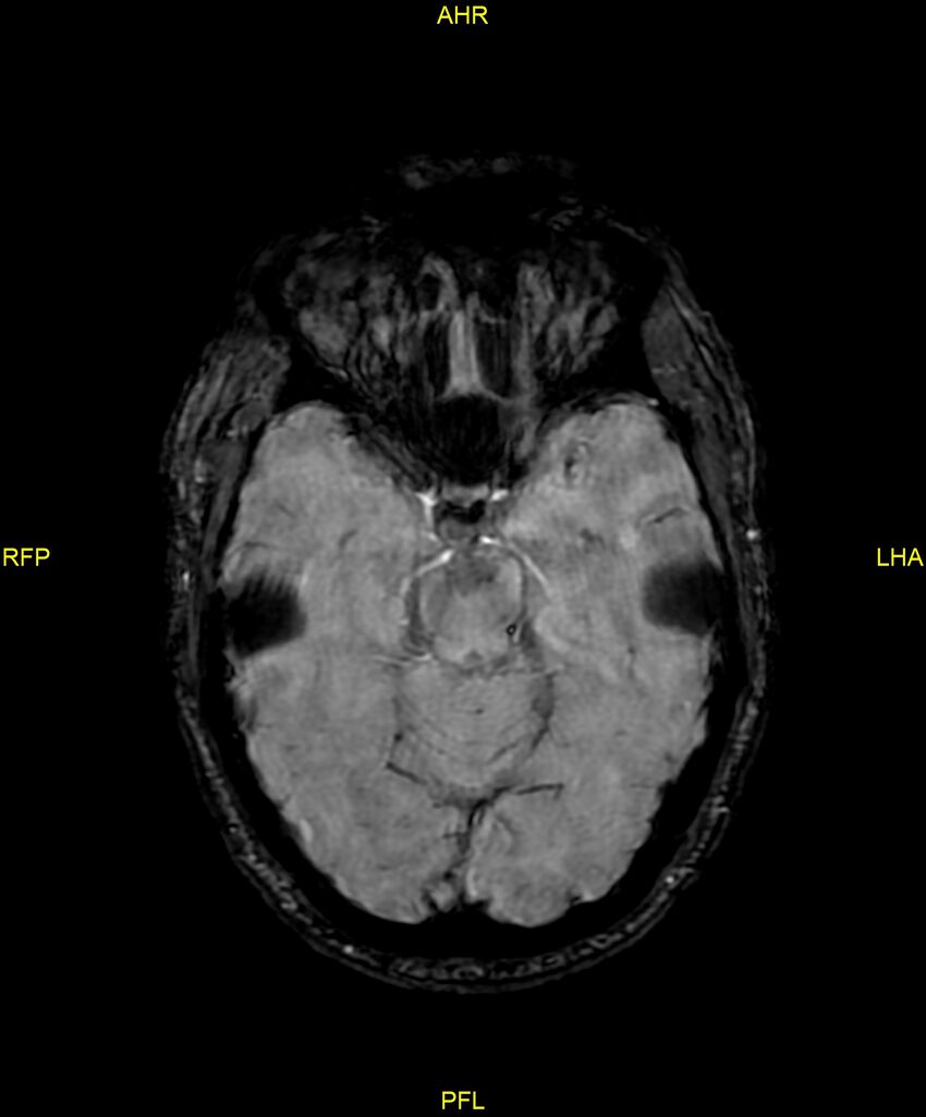 Cerebral autosomal dominant arteriopathy with subcortical infarcts and leukoencephalopathy (CADASIL) (Radiopaedia 86108-102054 Axial SWI 42).jpg