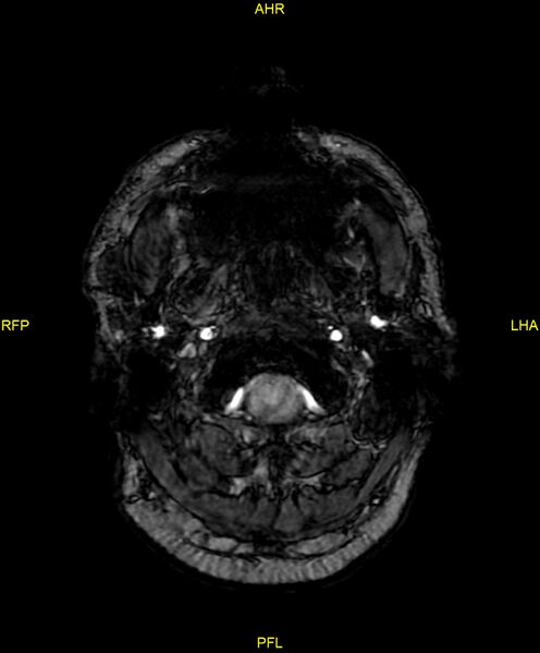 File:Cerebral autosomal dominant arteriopathy with subcortical infarcts and leukoencephalopathy (CADASIL) (Radiopaedia 86108-102054 Axial SWI 5).jpg