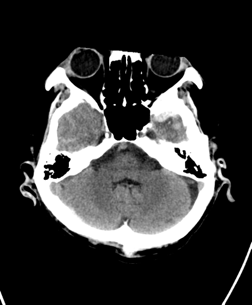 File:Cerebral contusions, subarachnoid hemorrhage and subdural hygromas (Radiopaedia 55399-61828 Axial non-contrast 7).png
