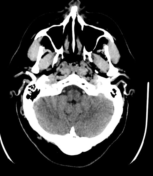 File:Cerebral dural venous sinus thrombosis (Radiopaedia 86514-102575 Axial non-contrast 8).jpg