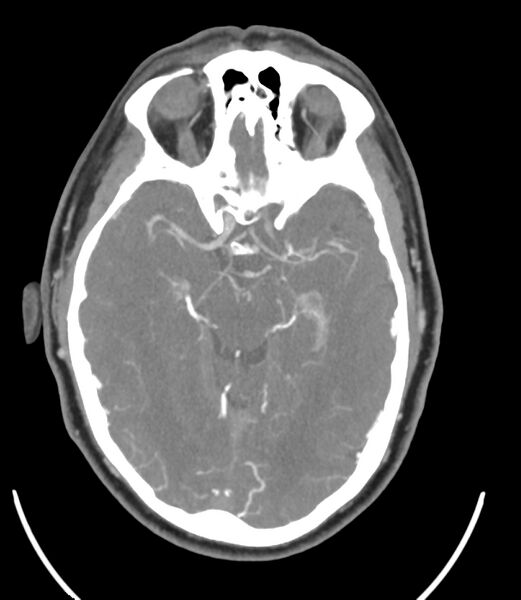 File:Cerebral dural venous sinus thrombosis (Radiopaedia 86514-102576 A 48).jpg