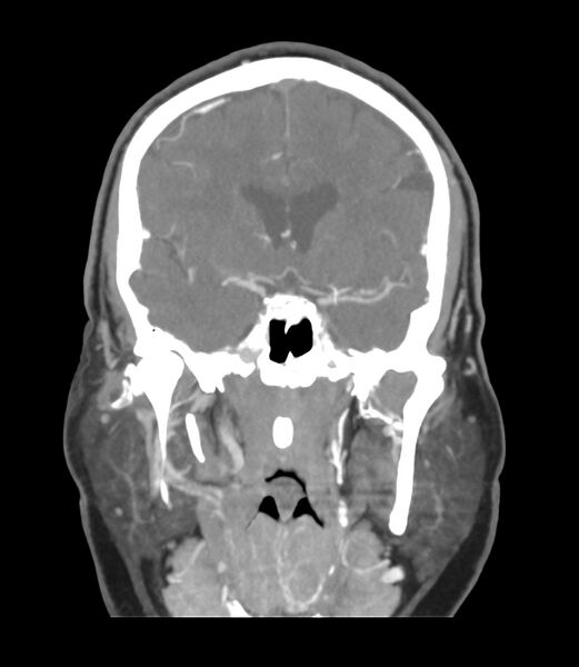 File:Cerebral dural venous sinus thrombosis (Radiopaedia 86514-102576 B 28).jpg