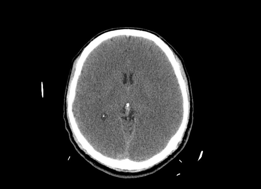 Cerebral edema (Radiopaedia 82519-96661 Axial non-contrast 27).jpg