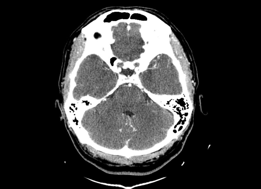 Cerebral edema (Radiopaedia 82519-96661 B 42).jpg