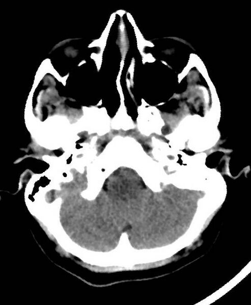 File:Cerebral edema due to severe hyponatremia (Radiopaedia 89826-106937 Axial non-contrast 14).jpg