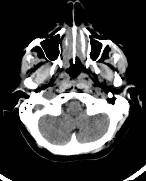 File:Cerebral edema due to severe hyponatremia (Radiopaedia 89826-106938 Axial non-contrast 16).jpg