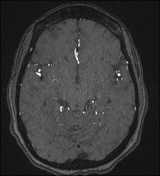 File:Cerebral fat embolism (Radiopaedia 35022-36525 Axial TOF 88).jpg