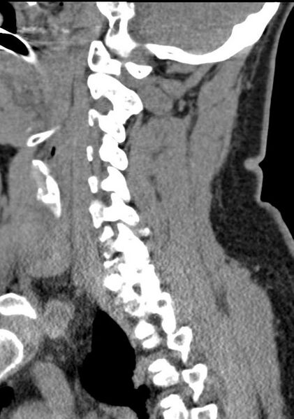 File:Cerebral hemorrhagic contusions and cervical spine fractures (Radiopaedia 32865-33841 G 69).jpg