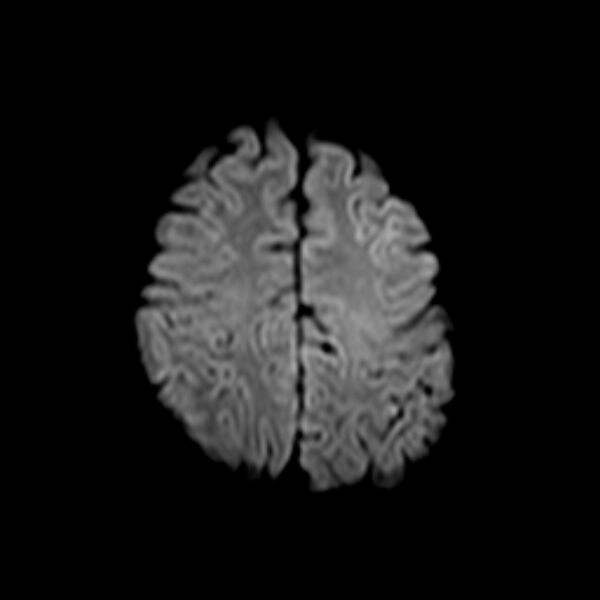 File:Cerebral tuberculoma (Radiopaedia 41152-43932 Axial DWI 19).jpg