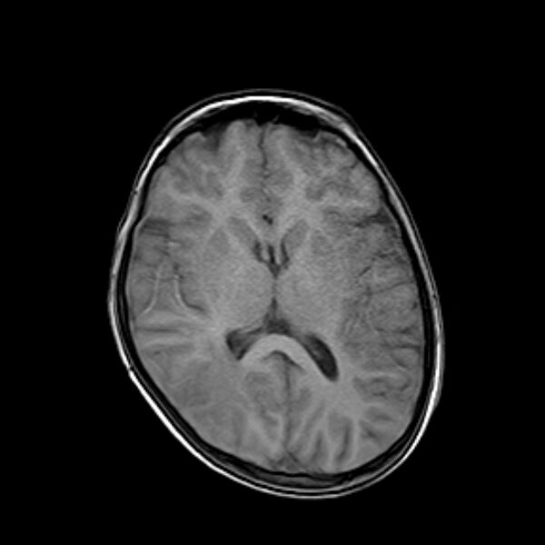 File:Cerebral tuberculoma (Radiopaedia 41152-43932 Axial T1 12).jpg