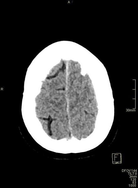 File:Cerebral venous sinus thrombosis (Radiopaedia 91329-108965 Axial non-contrast 44).jpg