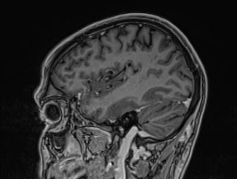 File:Cerebral venous thrombosis (Radiopaedia 71207-81504 Sagittal T1 C+ 13).jpg