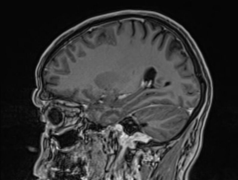 File:Cerebral venous thrombosis (Radiopaedia 71207-81504 Sagittal T1 C+ 43).jpg