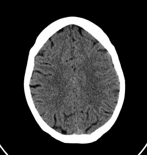 File:Cerebral venous thrombosis - CT only (Radiopaedia 41031-43778 Axial non-contrast 23).jpg