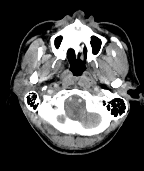 File:Cervical abscess (Radiopaedia 43725-47184 A 10).png