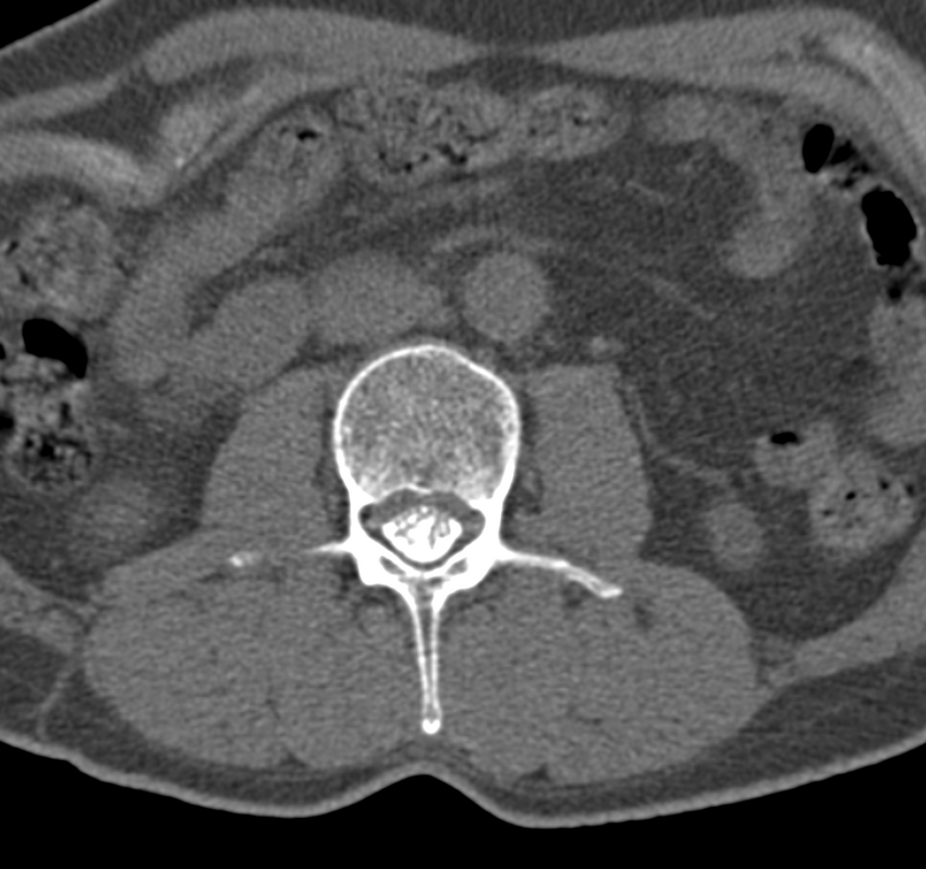 Cervical dural CSF leak on MRI and CT treated by blood patch (Radiopaedia 49748-54996 B 97).png
