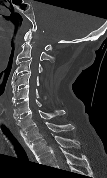 File:Cervical spine fracture - chalk stick (Radiopaedia 39116-41323 Sagittal bone window 28).png