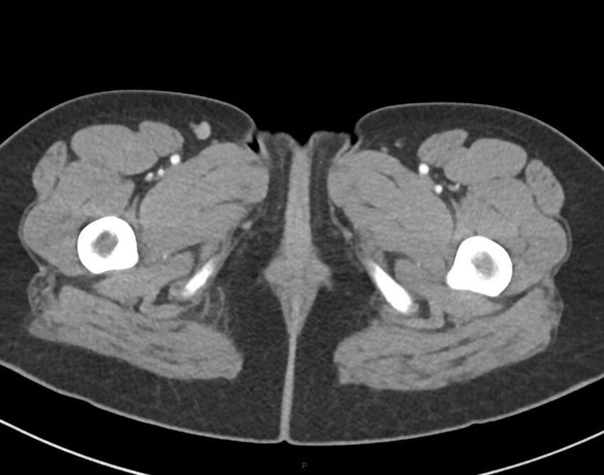 Cesarean scar endometriosis (Radiopaedia 82925-97262 A 96).jpg