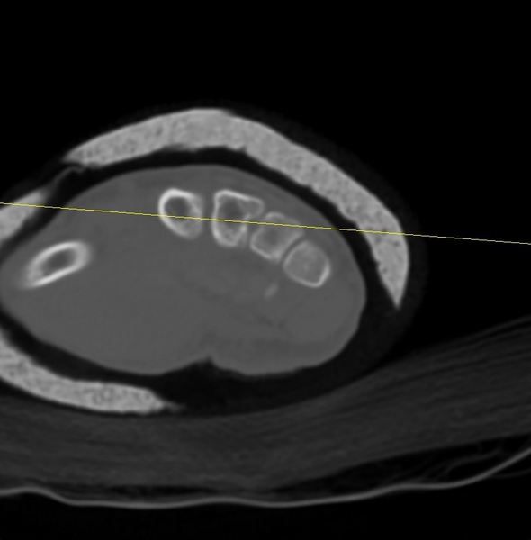 File:Chauffeur's (Hutchinson) fracture (Radiopaedia 58043-65079 Axial 27).png