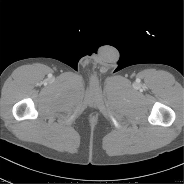 File:Chest and abdomen multi-trauma (Radiopaedia 26294-26426 A 98).jpg