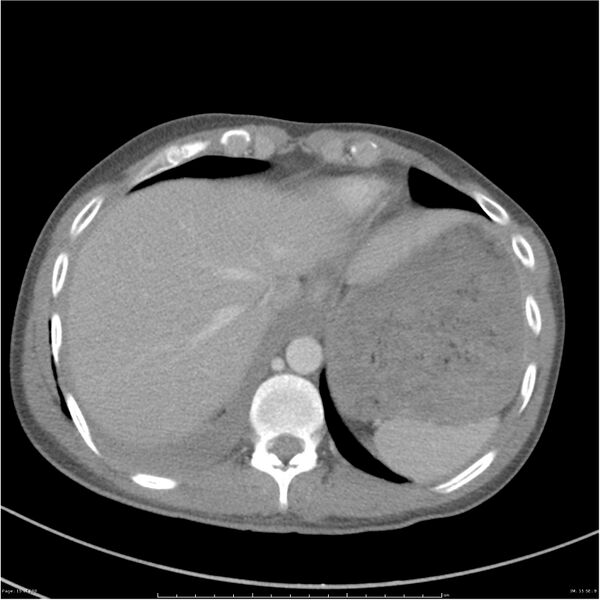 File:Chest and abdomen multi-trauma (Radiopaedia 26294-26426 bone window 15).jpg