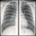 Chest x-ray - breathing (Radiopaedia 32556-33507 A 1).jpg