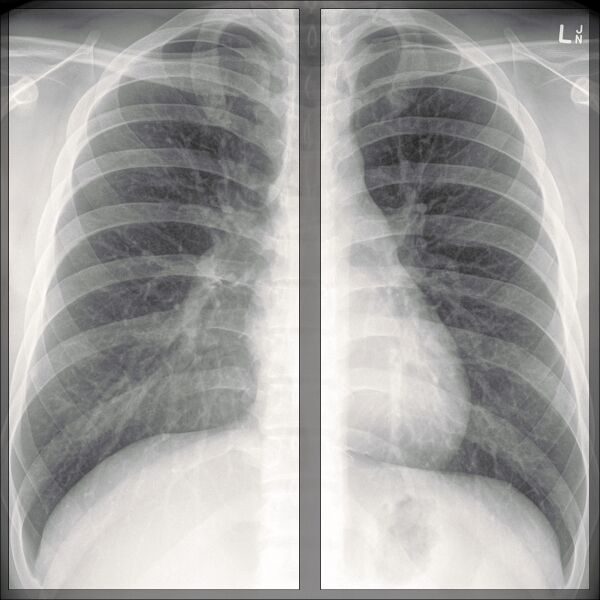 File:Chest x-ray - breathing (Radiopaedia 32556-33507 A 1).jpg