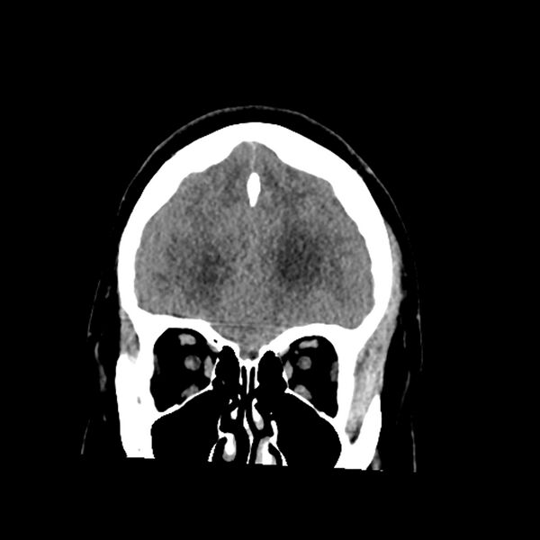 File:Chiasmatic-hypothalamic juvenile pilocytic astrocytoma (Radiopaedia 78533-91237 Coronal non-contrast 18).jpg