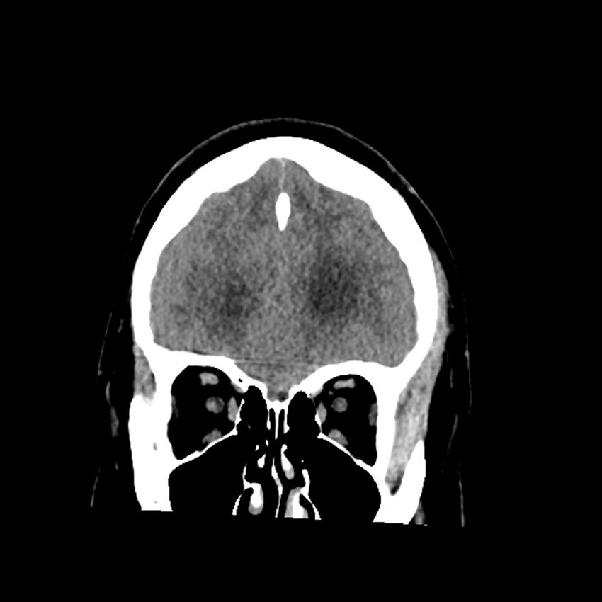 Chiasmatic-hypothalamic juvenile pilocytic astrocytoma (Radiopaedia 78533-91237 Coronal non-contrast 18).jpg