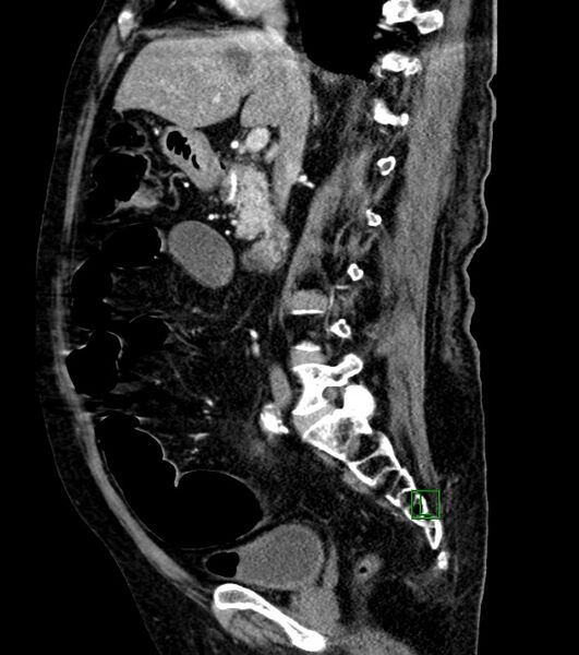 File:Cholangiocarcinoma with cerebral metastases (Radiopaedia 83519-98629 F 70).jpg