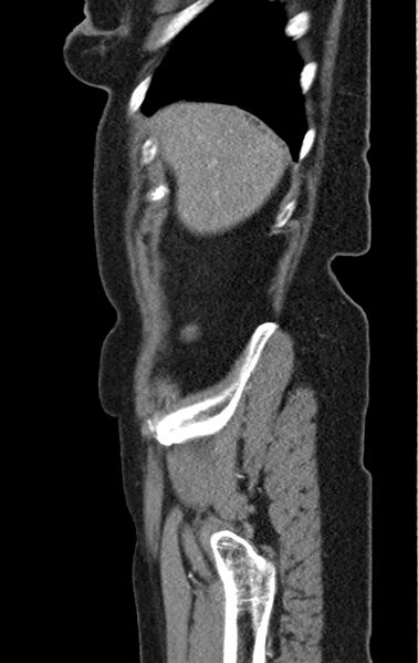 File:Cholecystoduodenal fistula due to calculous cholecystitis with gallstone migration (Radiopaedia 86875-103077 C 55).jpg