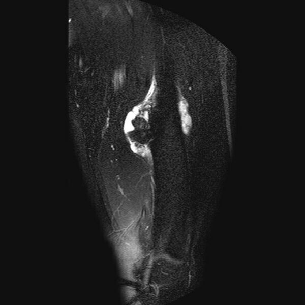 File:Chondrosarcoma arising from exostosis (Radiopaedia 59996-67686 C 8).jpg