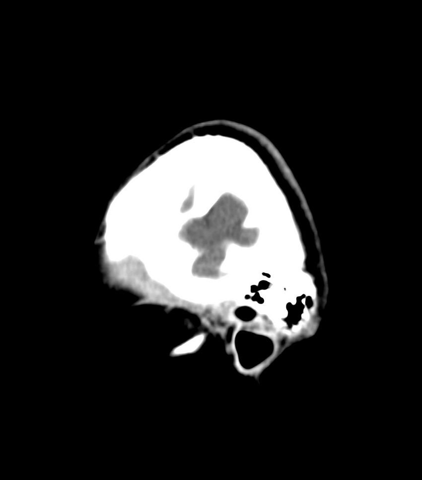Choroid plexus carcinoma (Radiopaedia 91013-108552 B 8).jpg