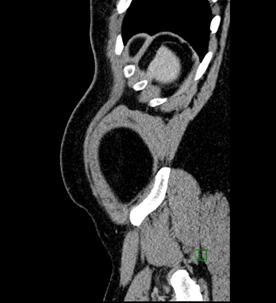 File:Chromophobe renal cell carcinoma (Radiopaedia 84286-99573 I 9).jpg