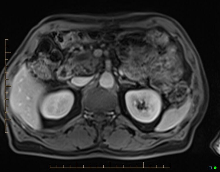 File:Chronic pancreatitis (Radiopaedia 17014-16716 Axial T1 C+ fat sat 32).jpg