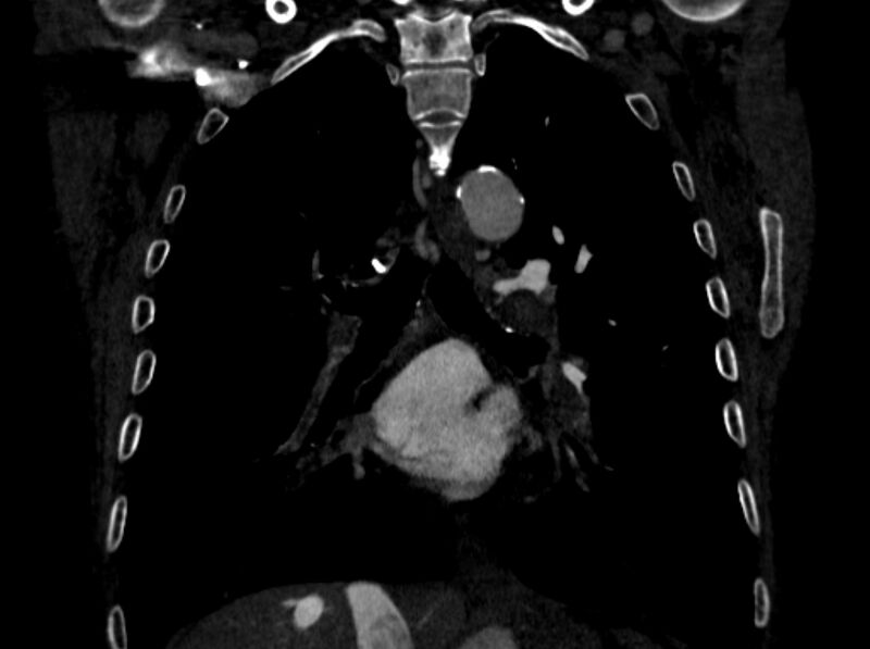 File:Chronic pulmonary embolism (Radiopaedia 91241-108843 A 63).jpg