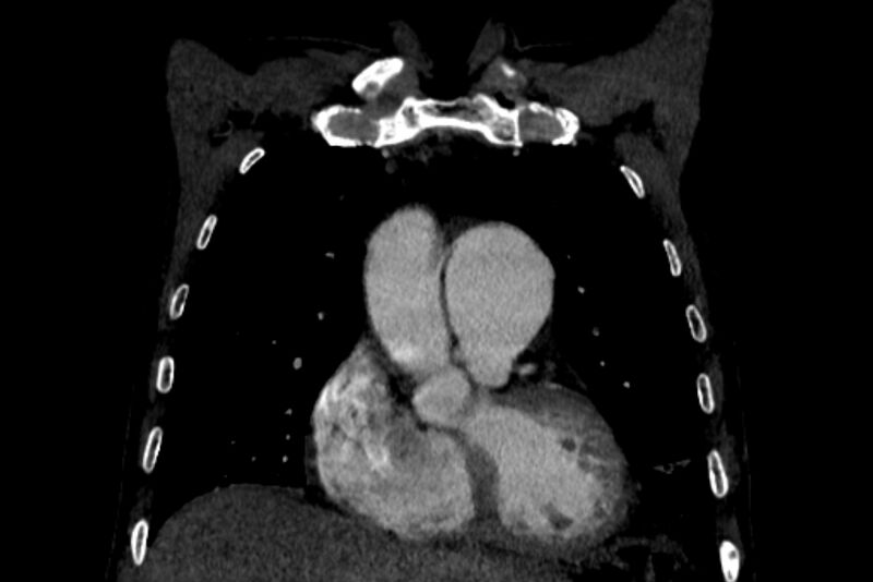 File:Chronic pulmonary embolism with bubbly consolidation (Radiopaedia 91248-108850 B 42).jpg