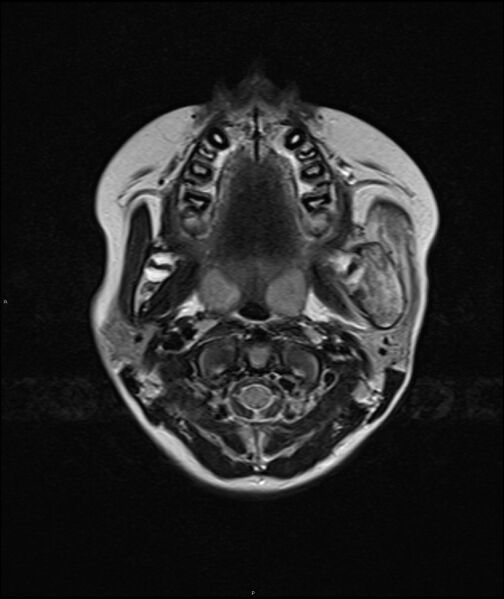File:Chronic reactive multifocal osteomyelitis (CRMO) - mandible (Radiopaedia 56405-63069 Axial T2 14).jpg