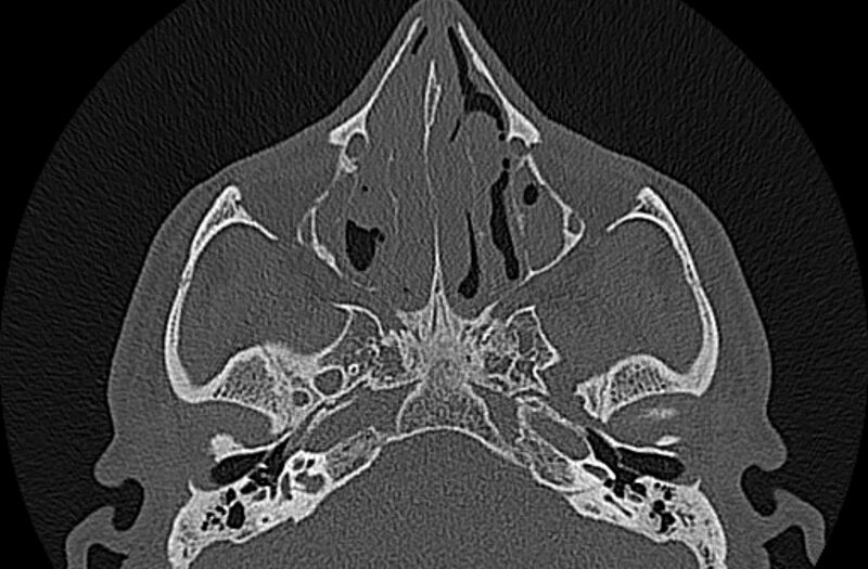 File:Chronic rhinosinusitis (Radiopaedia 65079-74075 Axial bone window 37).jpg