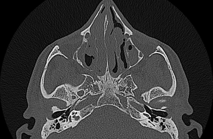 Chronic rhinosinusitis (Radiopaedia 65079-74075 Axial bone window 37).jpg
