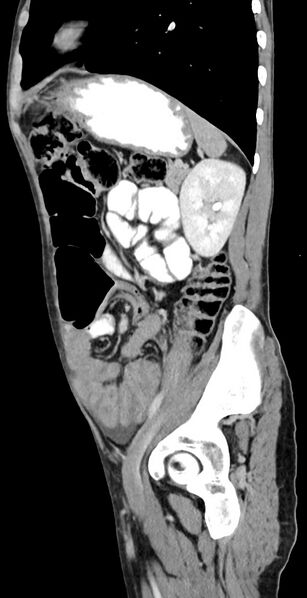 File:Chronic small bowel volvulus (Radiopaedia 75224-86322 C 47).jpg
