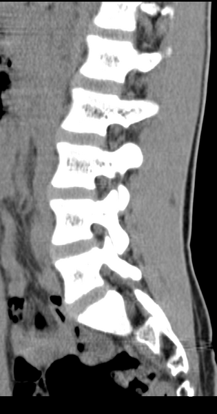 File:Clear cell meningoma - lumbar spine (Radiopaedia 60116-67691 A 28).png